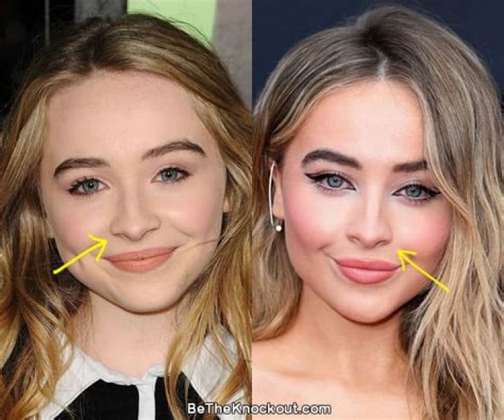 Did You Know: Sabrina Carpenter Lip Fillers