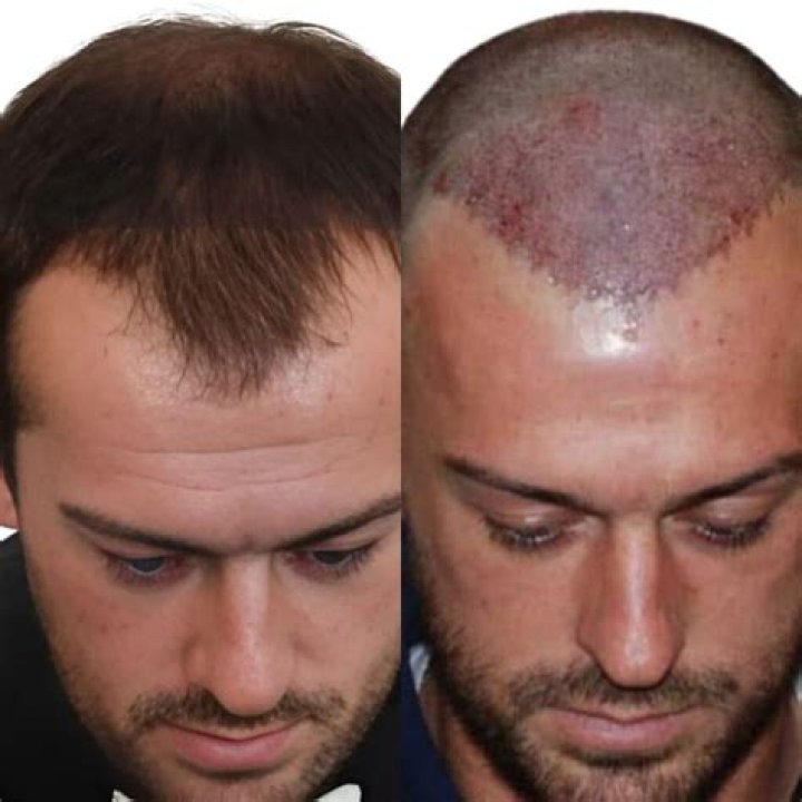 Did Zane Hijazi Just Get Hair Surgery and if Yes, Why?