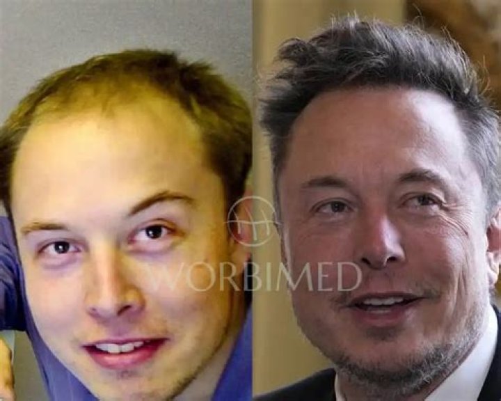 Elon Musk's Hair Restoration Journey: From Thinning To Confidence